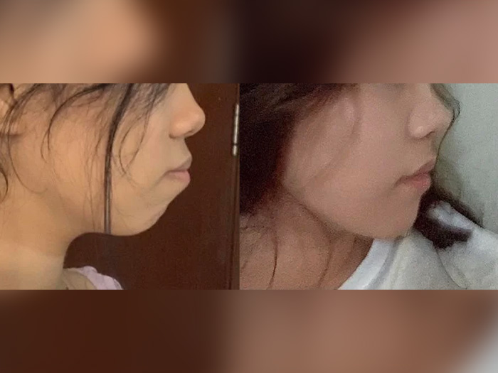 Weak chin improvement before and after mewing